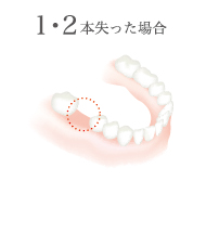 1・2本失った場合